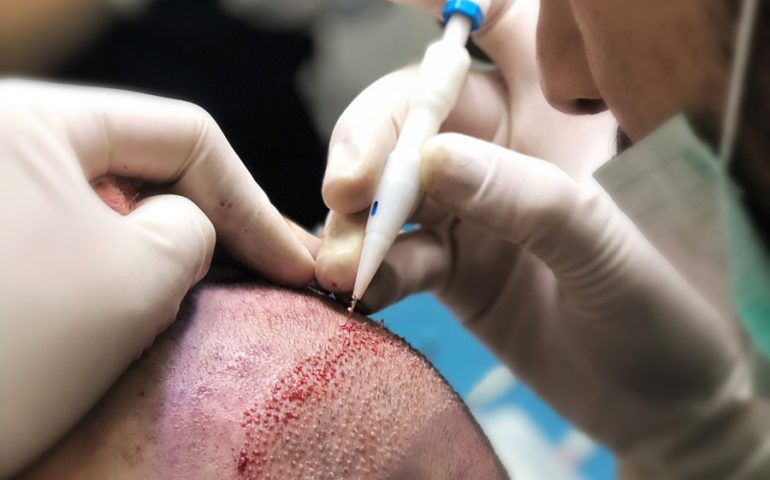  Greffe de cheveux Choi : Quels sont les résultats ?